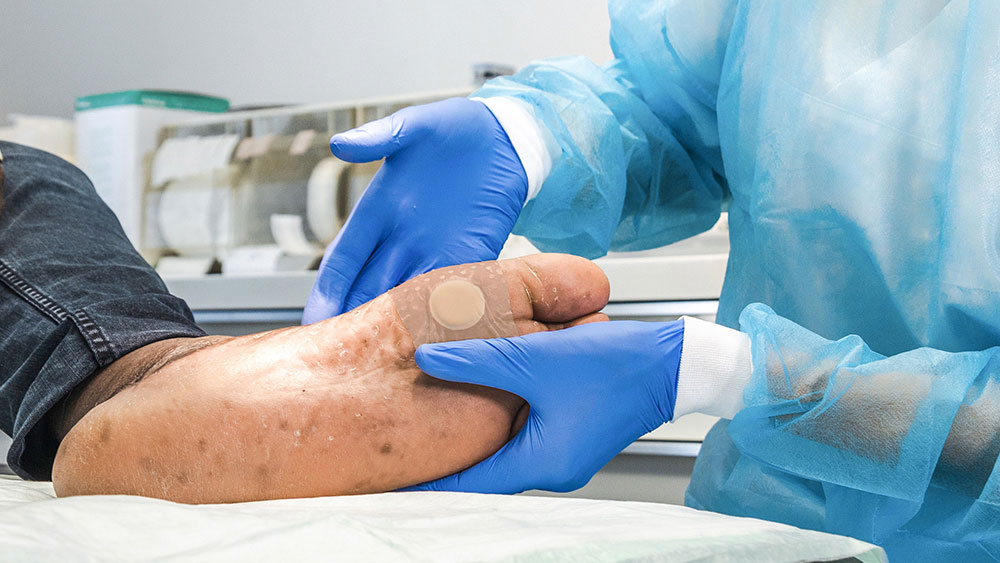 To hender med hansker holder en diabetesfot med plaster på, i bakgrunnen medisinsk materiell i et legerom